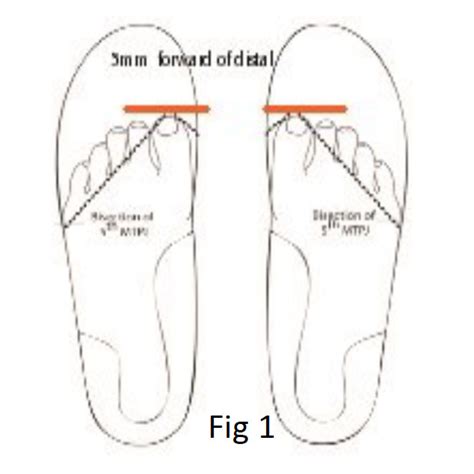 tibial torsion condition dlt chiropody