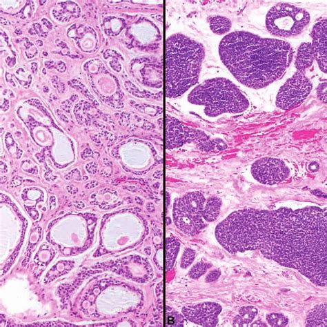pattern based grading in adenoid cystic carcinoma a tubular and