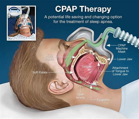 cpap  high blood pressure sleepquest