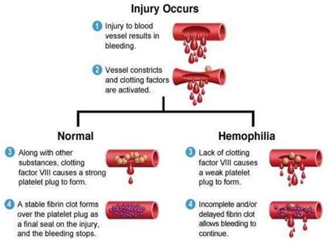 haemophilia causes symptoms and treatment mediologiest