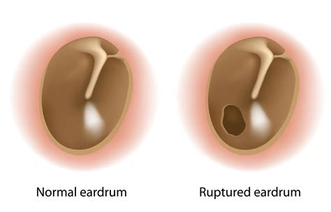 Tympanoplasty And Mastoidectomy Tympanomastoidectomy