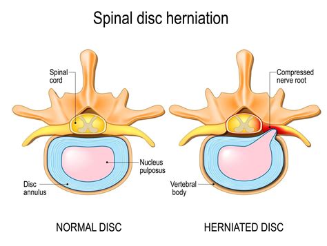 pain  herniated disc