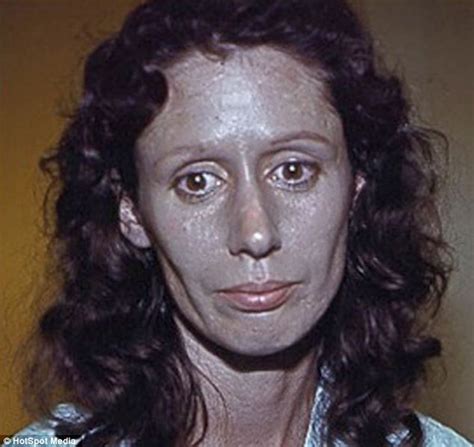 woman suffers argyria for 60 years after silver built up in her body