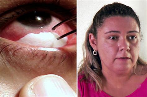 woman who cries crystal tears pulls 30 membranes out every
