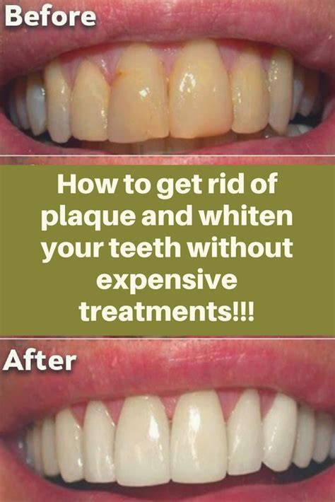 how to get rid of plaque and whiten your teeth without