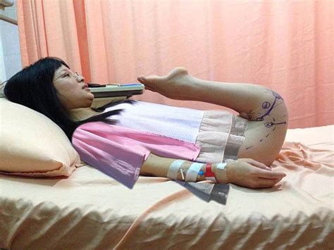 Woman In China Born With Rare Foot Deformity Walks For The First Time