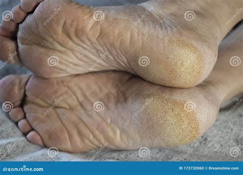 feet   patient  diabetes diabetic foot hyperkeratosis