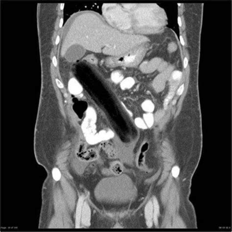 Buzz Lightyear And Mobile Phones Xrays Of Odd Objects Used In Sex