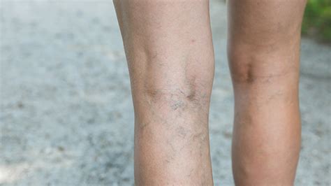 Spider Veins During Pregnancy What To Expect
