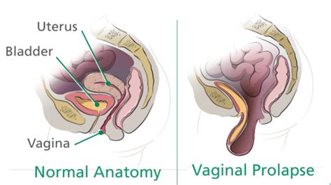prolapse advanced urogynecology of michigan pc