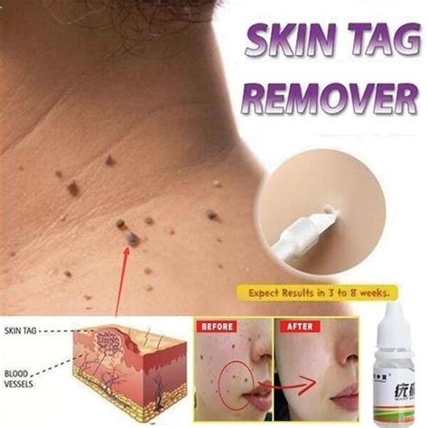 hot sale skin tag remover warts treatment foot corn