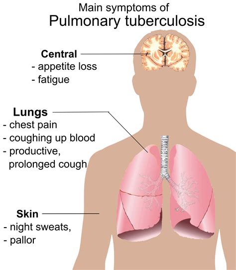 safe  painless homeopathic treatment  tuberculosis  pakistan