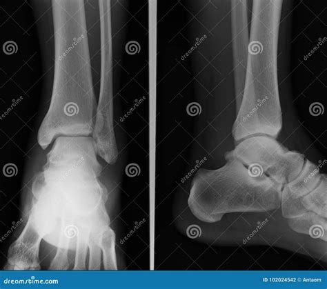 ray ankle ap lateral stock photo image  fibula