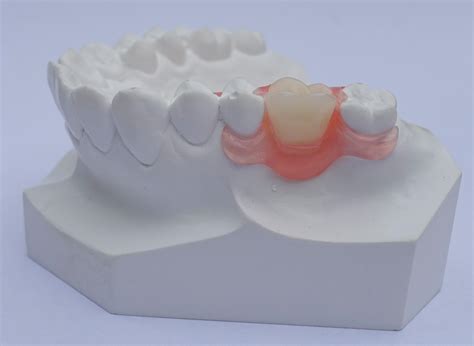begroting  implantaat tandartsnl forum
