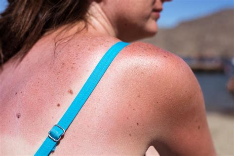 wat te doen bij zonnebrand   tips bij zonnesteek  verbrande huid