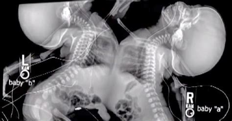 doctor panics when he sees mom s twins like this during ultrasound now watch what she does