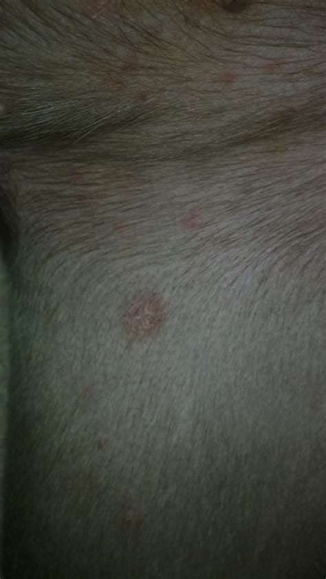 red bumps  blisters   weim
