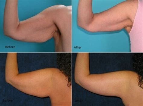 flabby saggy arms no more cream firming slim tightening cellulite fat