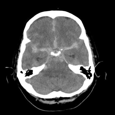 brain aneurysm mri scan   brain mri  differentiate