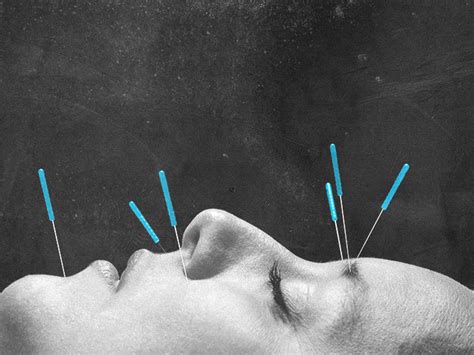 Acupuncture For Migraine What To Know