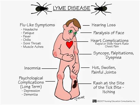 lyme disease   north river