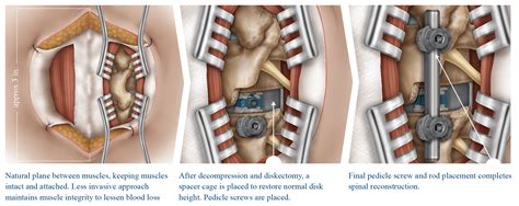 flif—far lateral lumbar interbody fusion dr antonacci s approach