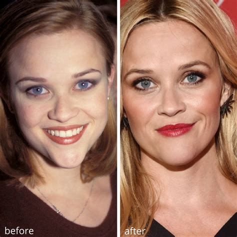 celebrity cheek fillers before and after all you need infos