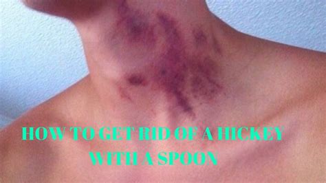 how to get rid of a hickey with a spoon youtube