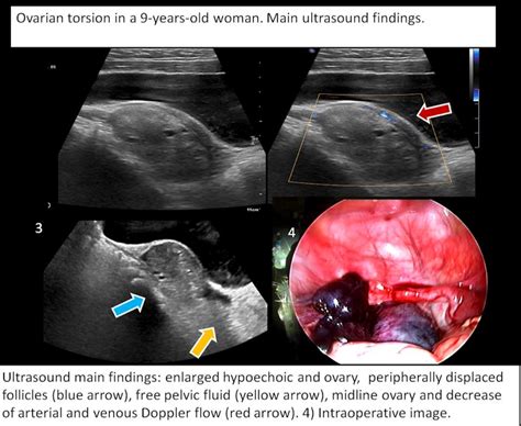 ovarian torsion    year  woman ultrasound main findings serau sociedad espanola de
