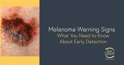 melanoma warning signs  images  skin cancer foundation