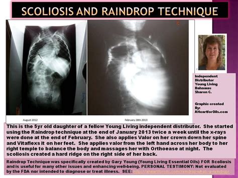 this testimony for raindrop therapy helping with scoliosis