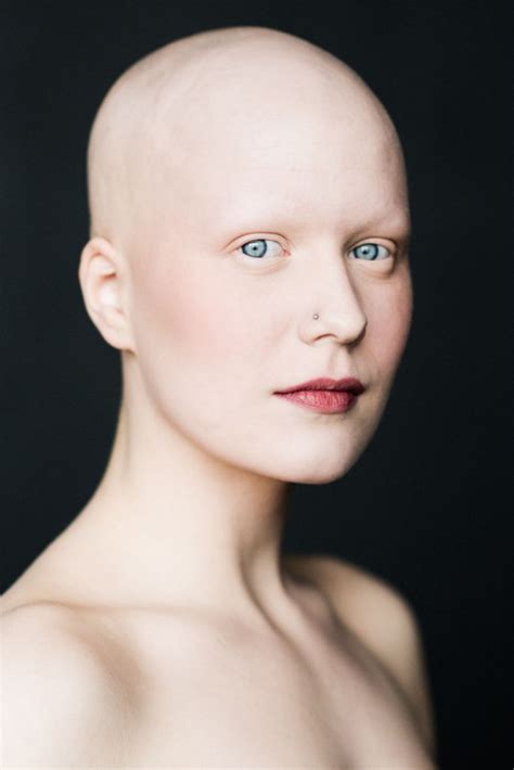 women with alopecia captured in beautiful pictures challenging gender