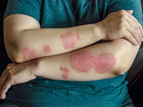 reasons   psoriasis treatment isnt working