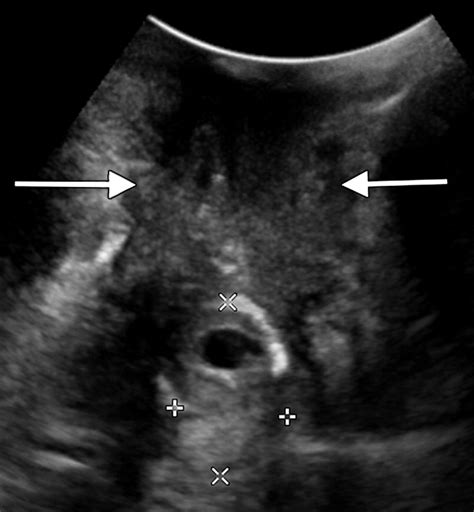 invited commentary on “us of the nongravid cervix with multimodality