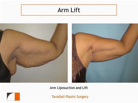 medical treatment pictures   understanding arm lift surgery