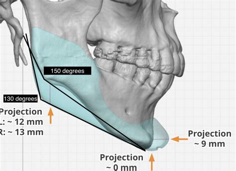 plastic surgery case study custom jawline implant design   high