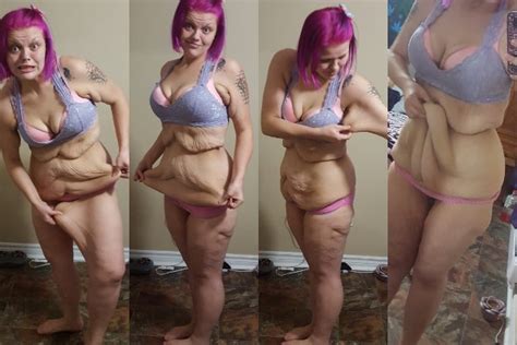 Woman Who Lost Nearly 200 Pounds Has Handfuls Of Loose