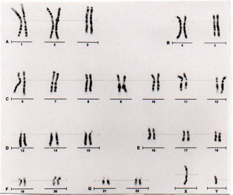 male chromosome causes symptoms treatment male chromosome