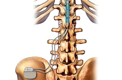 spinal cord stimulation  effectively treat painful diabetic