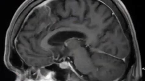 neurosurgical conditions  adult mri   brain st davids healthcast