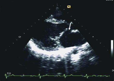 Isolated Cleft Mitral Valve In Adult Thoracic Key