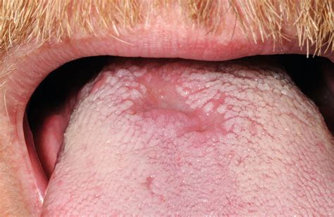 Syphilis On The Face In Primary Care A Rare Sign Of An Increasingly