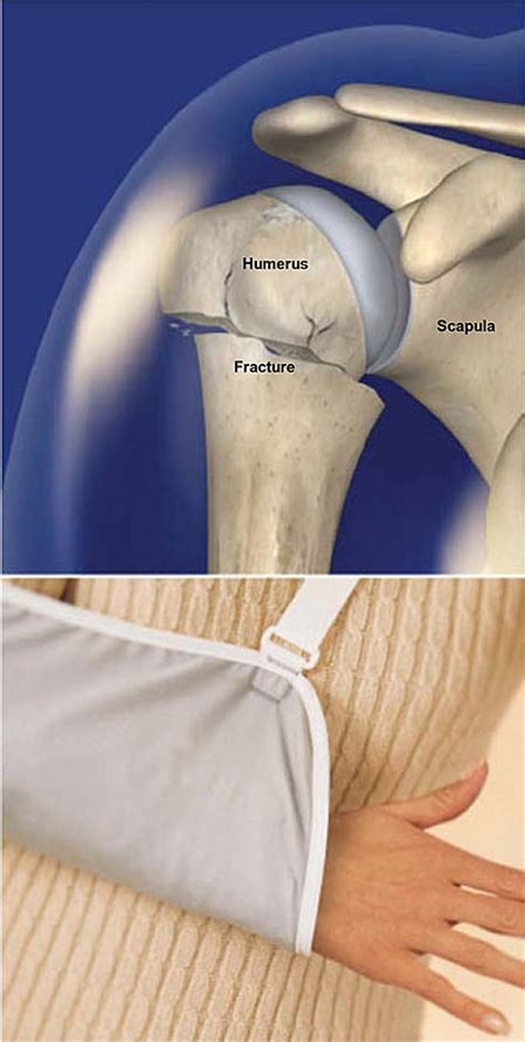 Proximal Humerus Fracture Broken Shoulder Central