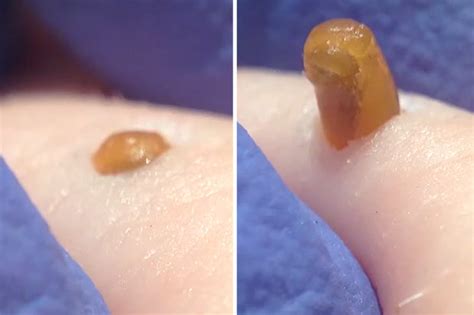 blackhead explodes in disgusting extreme close up viral video daily star