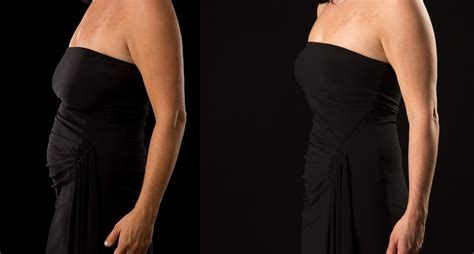 ottawa breast lift before and after 8 kanata plastic and cosmetic