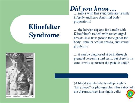 Ppt Klinefelter Syndrome Powerpoint Presentation Free Download Id