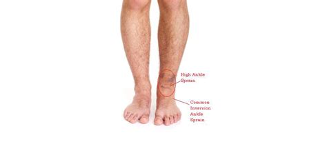 high ankle sprain treatment burlington sports therapy