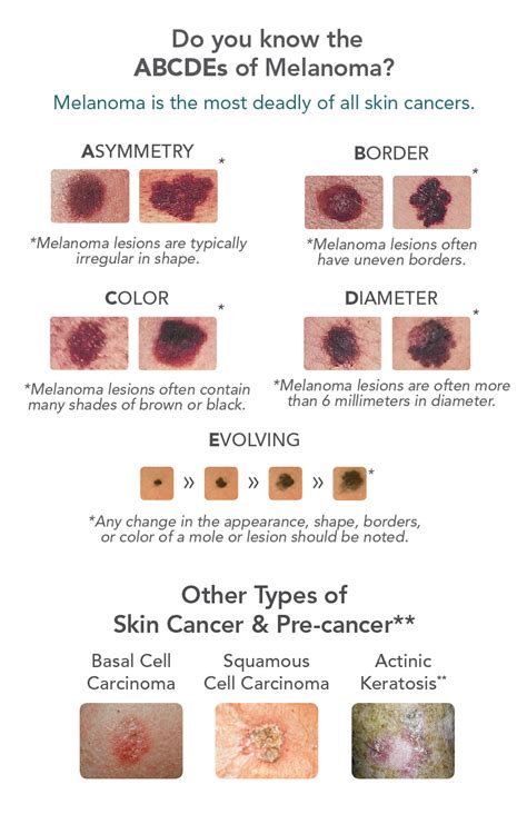 skin cancer warning signs associates  dermatology