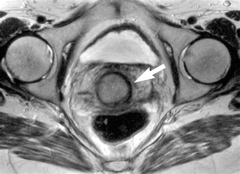 mr imaging of cervical carcinoma a practical staging approach