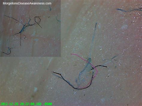 morgellons disease awareness morgellons disease physicians reference guide of symptoms with